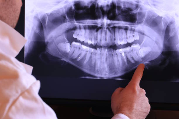 Best Emergency Dental Care for Abscessed Tooth in Stanford, CA